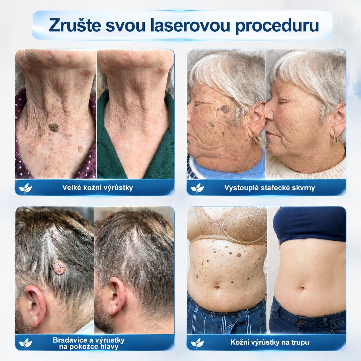 💙💙Oficiální značkový obchod | Hiskin® 7denní odstraňovač skvrn a pigmentových skvrn (Bezbolestný rollerball bez jizev)🐬