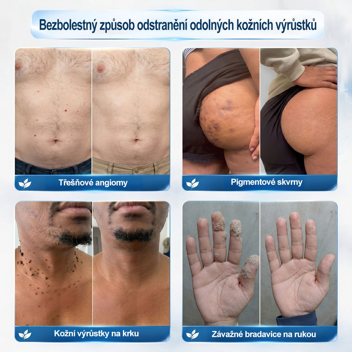 💙💙Oficiální značkový obchod | Hiskin® 7denní odstraňovač skvrn a pigmentových skvrn (Bezbolestný rollerball bez jizev)🐬
