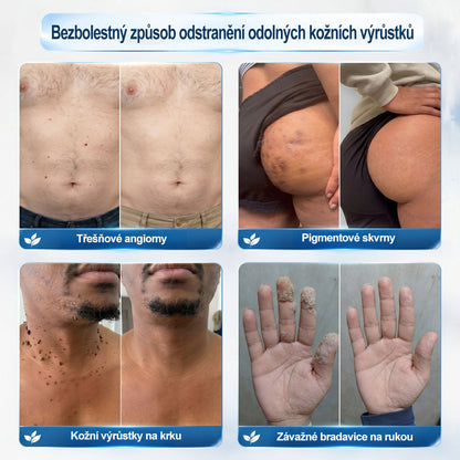 💙💙Oficiální značkový obchod | Hiskin® 7denní odstraňovač skvrn a pigmentových skvrn (Bezbolestný rollerball bez jizev)🐬